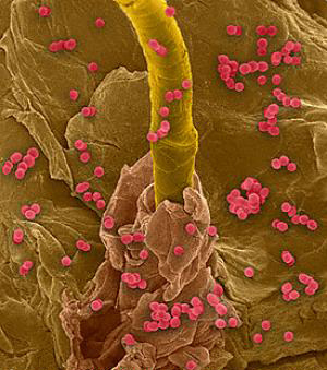 Bacteria around hair follicle
